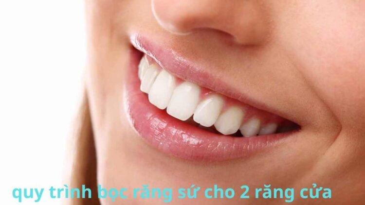 quy trình bọc răng sứ 2 răng cửa